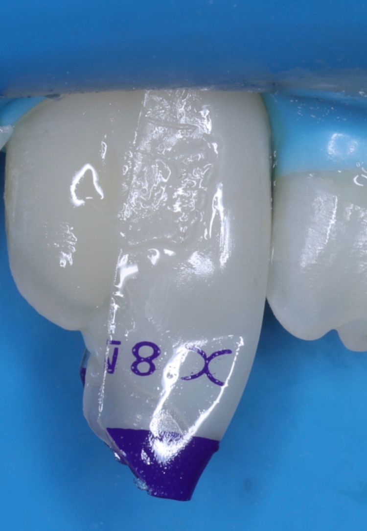 Bioclear matrix in place on an incisor before composite placement