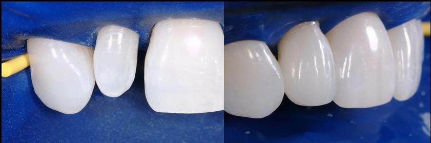 Before and after incisor restorations under isolation