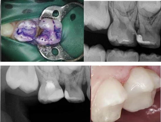 Isolation, imaging and a completed molar restoration