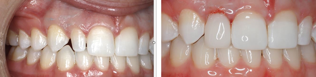 Before and after anterior case