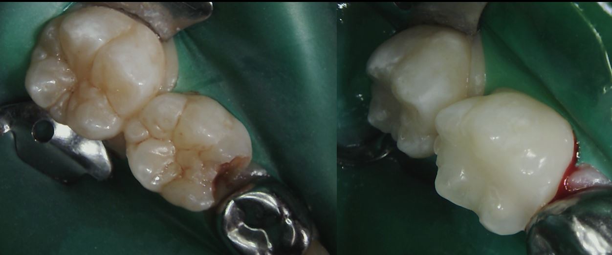 Molar restorations under rubber dam isolation