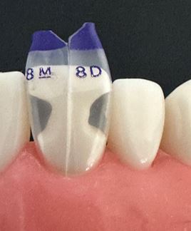 Twin anterior matrices marked for the mesial and distal contacts