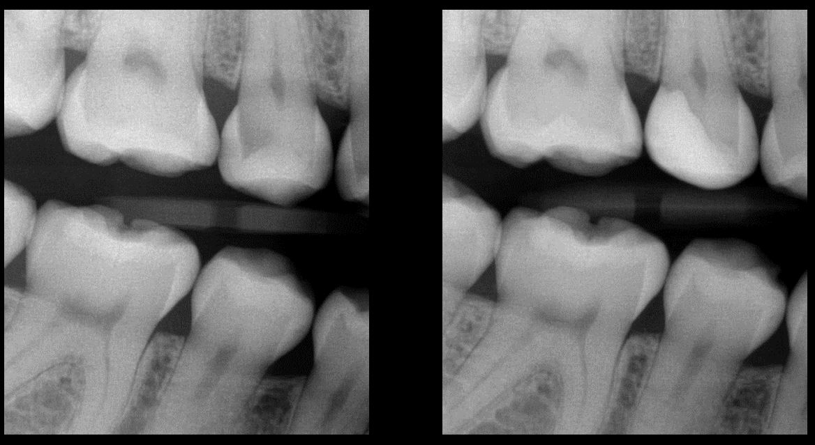 Before and after bitewing radiographs