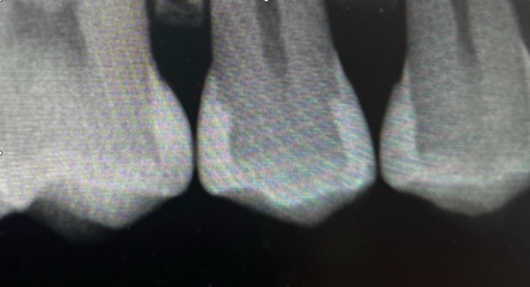 Post-operative radiograph of restored teeth