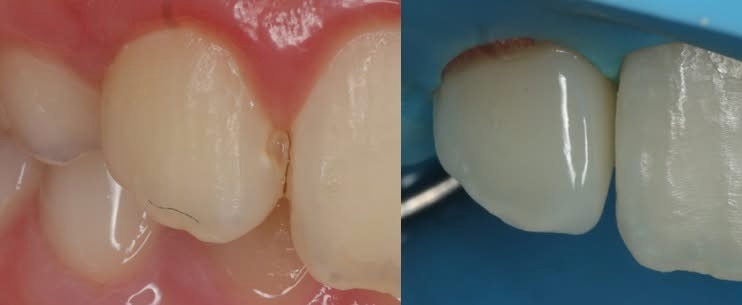 Before and after anterior restoration under rubber dam isolation