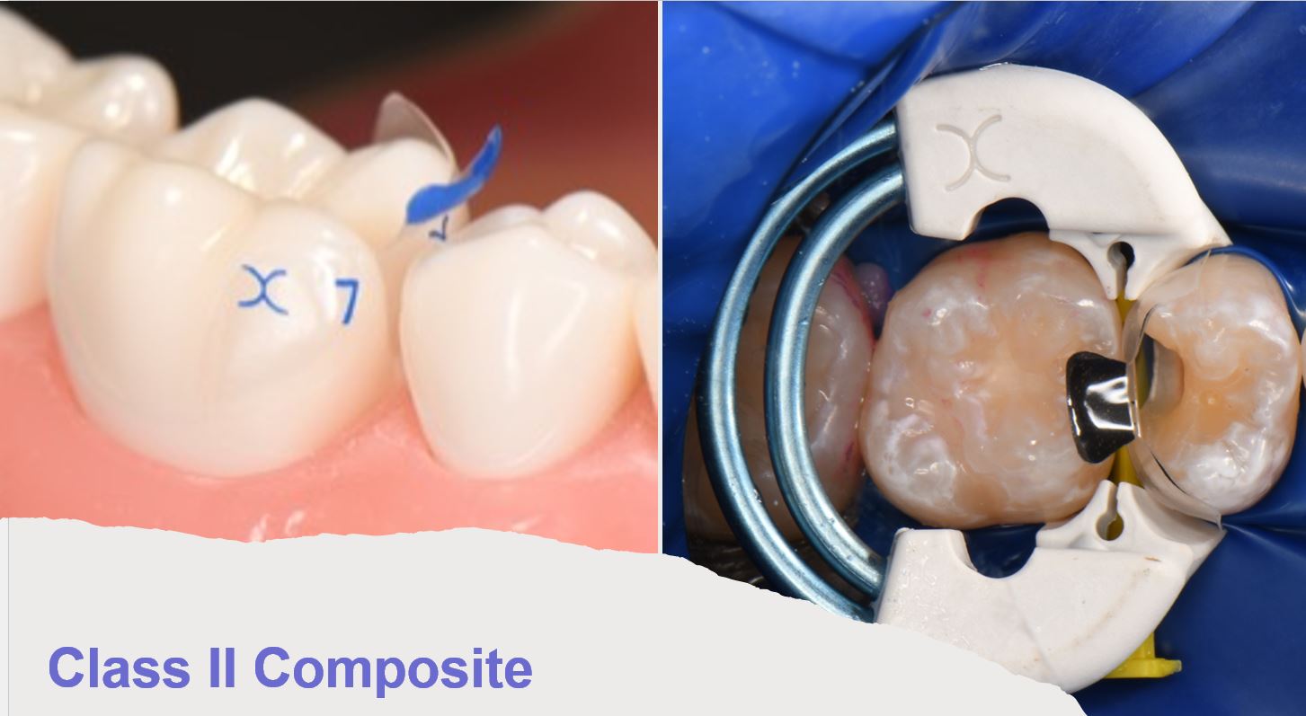 Class II composite with the Bioclear matrix in place
