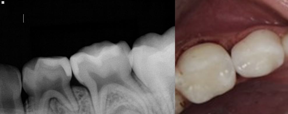 Radiograph and clinical photo of restored molars