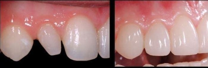 Before and after anterior restoration