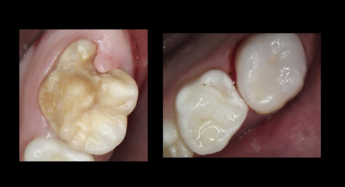 Before and after molar restoration
