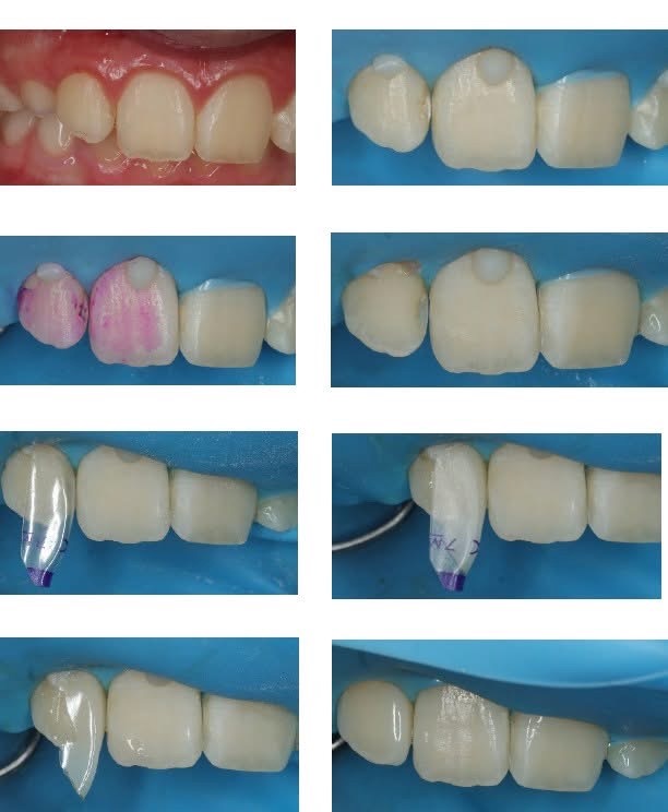Step-by-step anterior case from preparation to finished composite